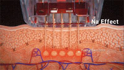 Sylfirm X黑曜双波如何创造皮肤科增量6.jpg